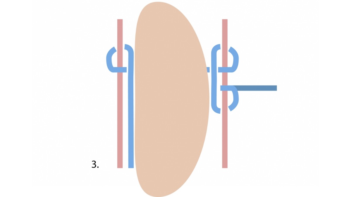 ¿Cómo rizar una piedra de macramé? : Paso 3 ¿Cómo rizar una piedra de macramé? : Paso 3